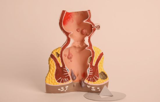 Hämorrhoiden und Inkontinenz